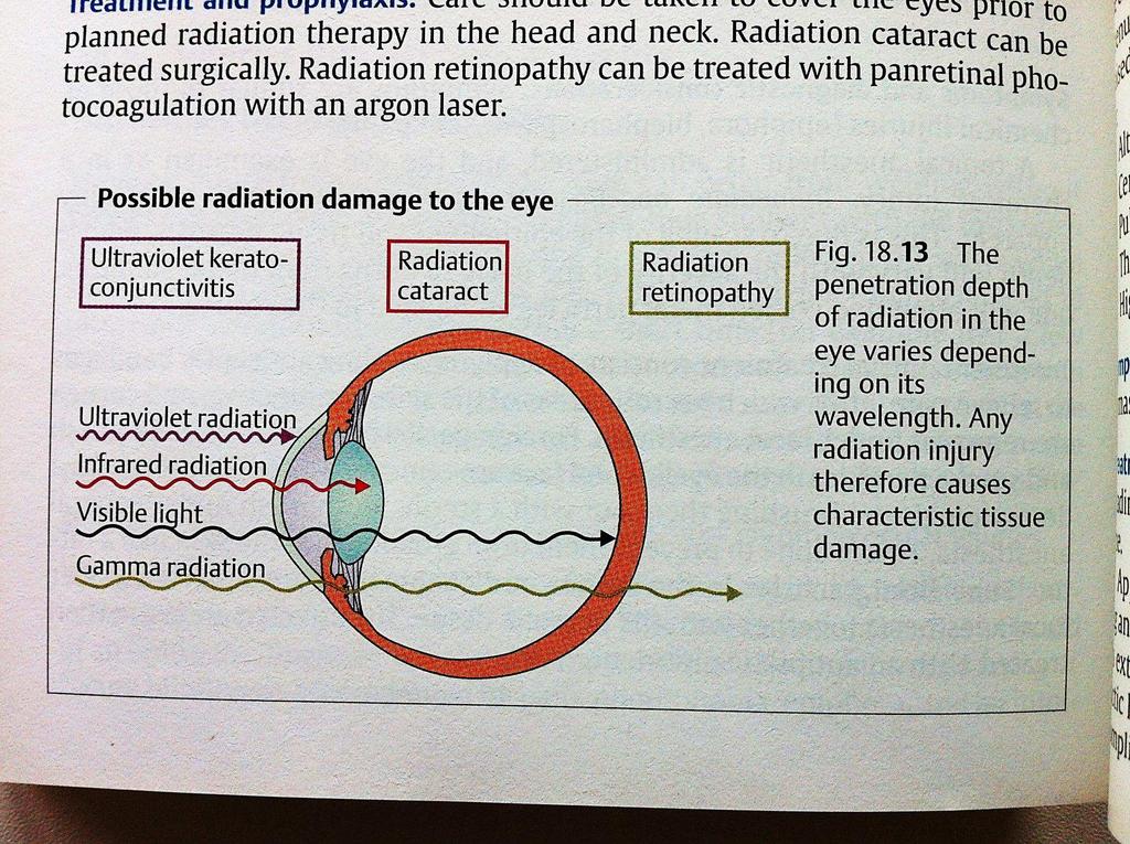 Üvegfúvók szürkehályogja Elektromos sérülés Villám / áramütés Cataracta electrica/ e fulgure Maculaoedema Rtg sugárzás (CT vagy irradiatio) cataracta Látható fény