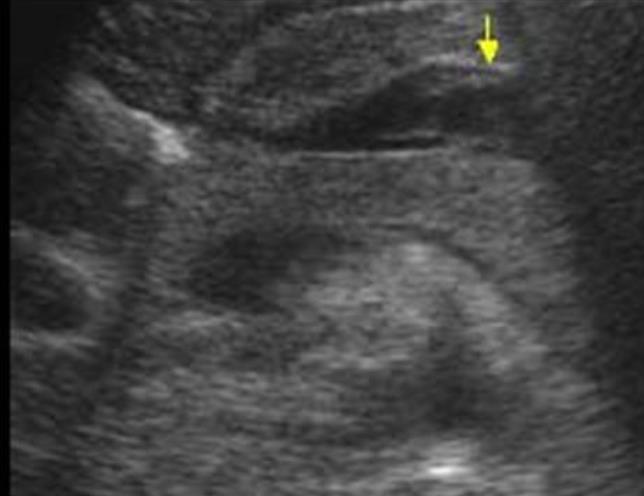 PANCREAS SÉRÜLÉS SZÖVŐDMÉNY: pancreatitis fistula pseudocysta abscessus Kiszélesedett pancreas, körülötte folyadék, elmosódott