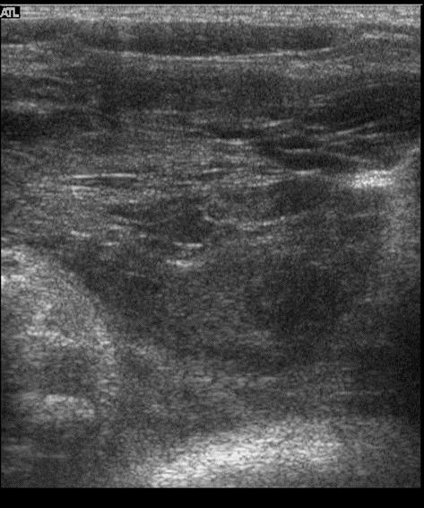 DUODENUM- ÉS BÉLSÉRÜLÉS Leggyakrabban duodenum 2-3. szakaszon. Fali megszakadás, oedema, haematoma, focalis fali megvastagodás. Intramuralis gáz.