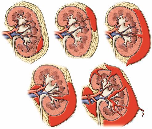 VESESÉRÜLÉS I. Contusio vagy nem növekedő subcapsularis haematoma II.