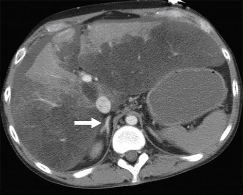 HYPOPERFUSIOS COMPLEX Diffuse bélfali megvastagodás, dilatatio mesenterialis vasoconstrictio Ismeretlen eredetű ascites Rendellenes halmozás: - bélfalban - mesenteriumban