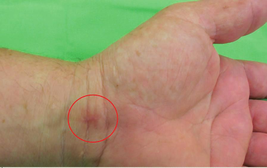 Carpal tunnel szindróma sikertelen kezelése minimal invazív eljárással mind gyakoribb felismerése pedig a CTS népbetegség látszatát keltheti.
