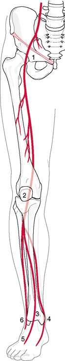 Saját gyakorlat ASA/CLO Iliacalis PTA: ASA/CLO Stent: ASA + CLO