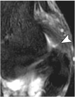 HAGL LAESIO Labrum