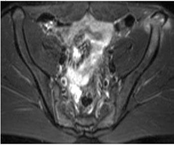 MRI MRI Társsérülések