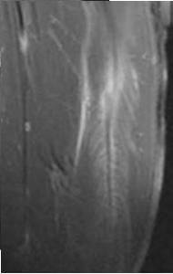 átmenet Myofascialis régió Ín