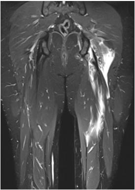 PROXIMALIS HAMSTRING