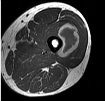 HAEMATOMA AZ M.