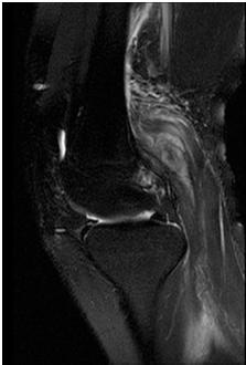 HAEMATOMA A M.