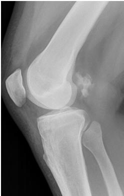 MYOSITIS OSSIFICANS