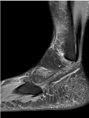 a ii. fokú talus navicularis ízületi arthrosis)