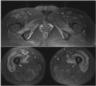 KÓROS IZOM MR MORFOLÓGIA INFLAMMATORIKUS MYOSITIS Ödéma leggyakoribb Trauma