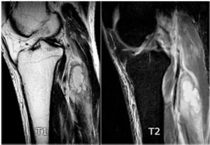 ENDOKRIN OPTHALMOPATHIA http://www.radiologyassistant.