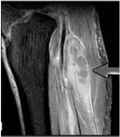 html INFEKTIV MYOSITIS PYOMYOSITIS Predisponál: DM, immunhiány, penetráló