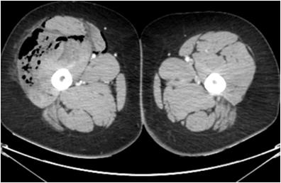 PYOMYOSITIS