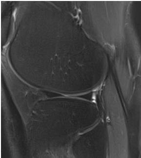 KÜLÖNLEGES SZALAGOK KÓROS ÍN / LIGAMENTUM MR