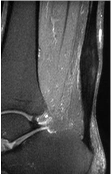 B Stetson, JBJS, 2005 (87) TENDINOSIS ACHILLES
