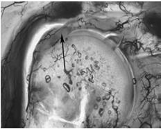 Lig. popliteomeniscale Wrisberg ligamentum Alaki