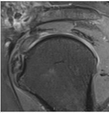 tendinitis Peritendinitis Tenosynovitis Szakadás