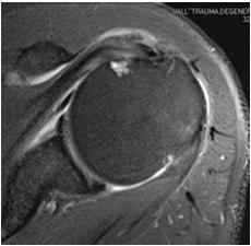 Mucoid degeneráció Enthesitis Megnyúlás?