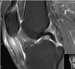 PATELLA ÍN
