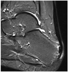 vagy tenosynovitis