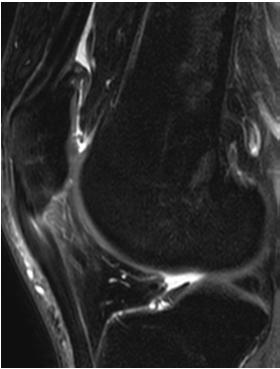 PERITENDINITIS ACL