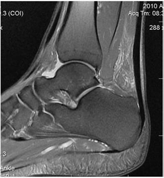 ENTHESITIS