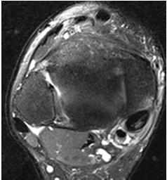 TP TENDINOPATHIA I.