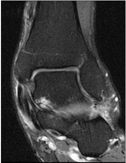 tenosynovitis társulhat