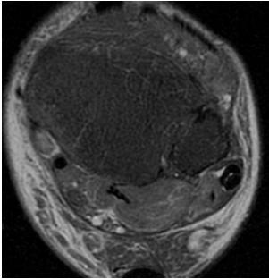 ruptura TP TENDINOPATHIA