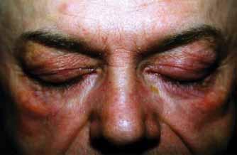 kéz MCP- és PIP-ízületei felett), heliotrop rash (periorbitalis erythema a szemhéjakon, amelyekhez gyakran társul oedema, és a felső szemhéj gyakrabban érintett, mint az alsó) (1 4. ábra).