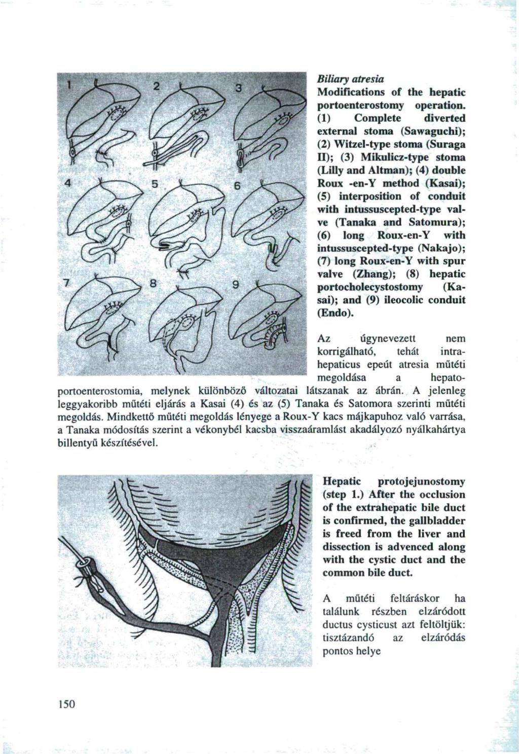 Biliary atresia Modifications of the hepatic portoenterostomy operation.