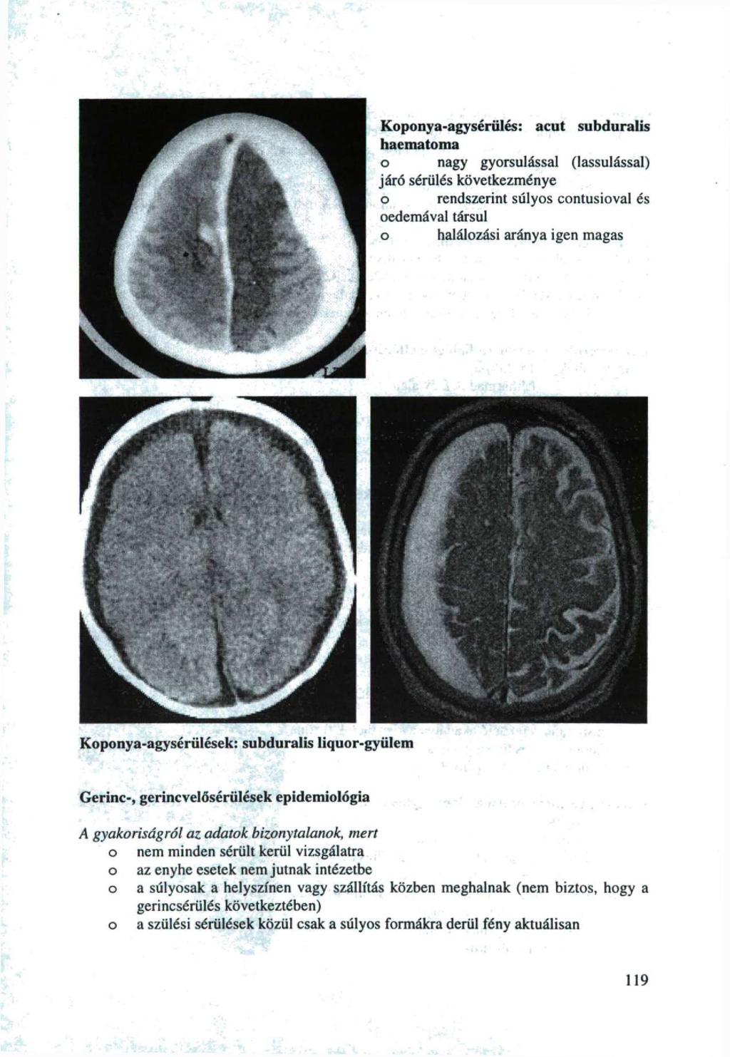 Kpnya-agysérülés: acut subduralis haematma nagy gyrsulással (lassulással) járó sérülés következménye rendszerint súlys cntusival és edemával társul halálzási aránya igen magas Kpnya-agysérülések: