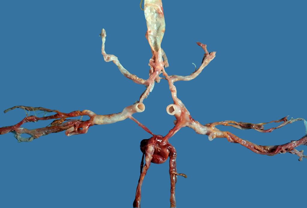 Bogyó aneurysma: veleszületett, lassan