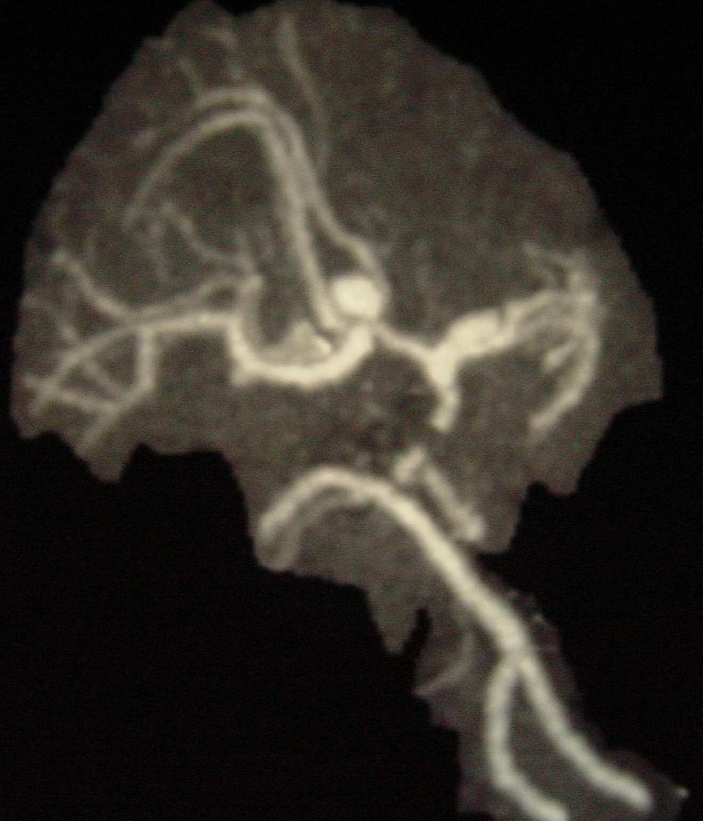 Jobbára a circulus arteriosus