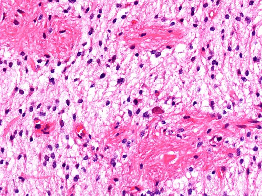 Pilocytás astrocytoma Gr I: a