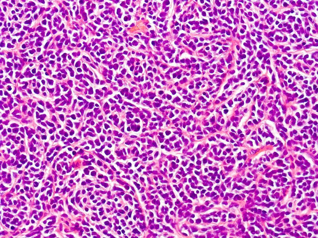 Medulloblastoma: atypusos,