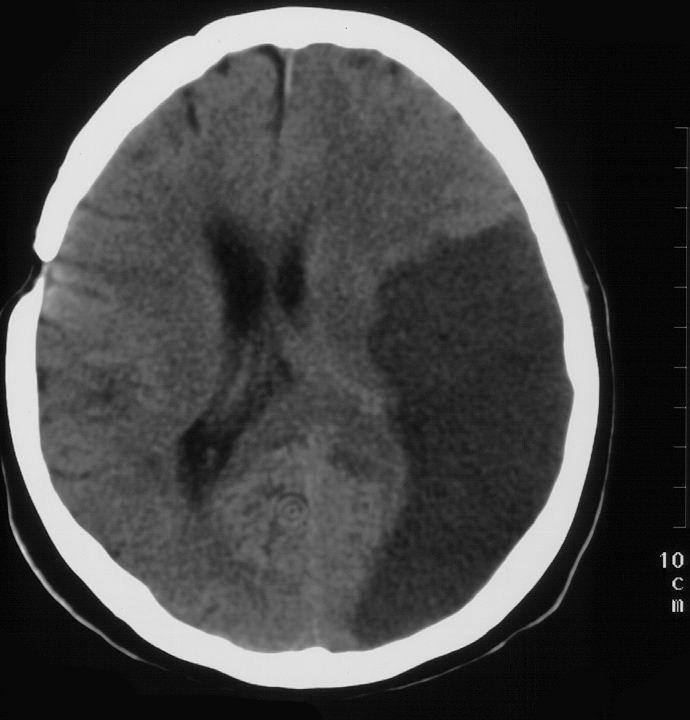 A. cerebri media thrombosis.