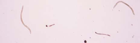 megbetegedések: 8 fonálféreg ismert, ami emberben megbetegedést okozhat A WHO zászlaja Oncocherca volvulus folyami vakság