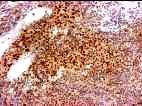 + DEN TGF-β1 + DEN Dec -/- /TGF-β1 + DEN 18. ábra. Immunhisztokémia. A.