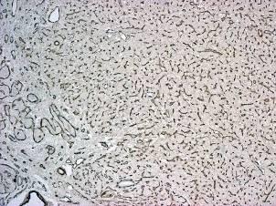 agrin CD31 CD34 3b. ábra: Agrin, CD31 és CD34 immunhisztokémia HCC-n.
