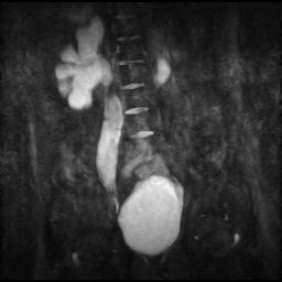 MR- Urographia Előny 1. Nincsen sugárterhelés 2.