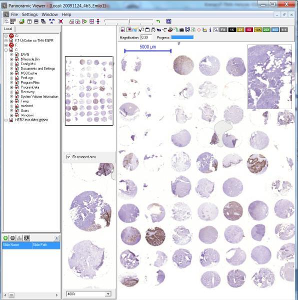 10.Ábra. Az emlőkarcinómás esetekből készült TMA metszet digitalizált HER2 immunreakcióinak a Pannoramic Viewer platformon megjelenő kis és nagy nagyítású képei saját anyagból.