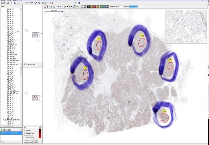 3.2. Markerek hagyományos, illetve digitalizált metszeteken történő kiértékelésének összehasonlítása A hagyományos, mikroszkópos és digitális lemezen történő összehasonlítást összesen 186, a