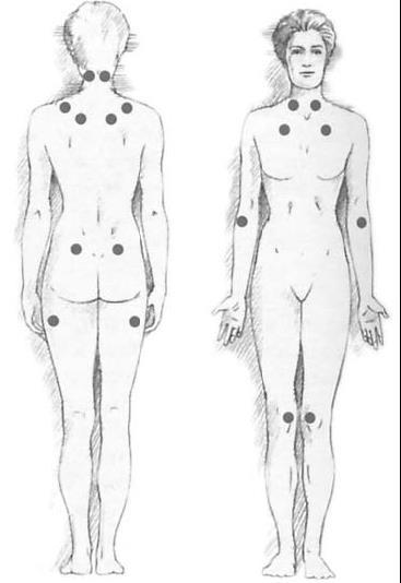 Fibromyalgia és nyomás okozta fájdalom (pressure pain) (Gracely et al.