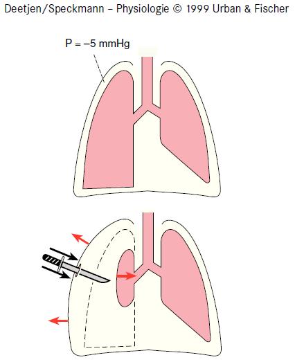 A tüdő elastic recoil demonstrációja: a légmell (Pneumothorax).