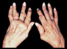 Definició A rheumatoid arthritis (RA) ismeretlen eredetű, autoimmun patomechanizmusú, krónikus, progresszív sokízületi gyulladás, mely az ízületek destrukciója miatt súlyos