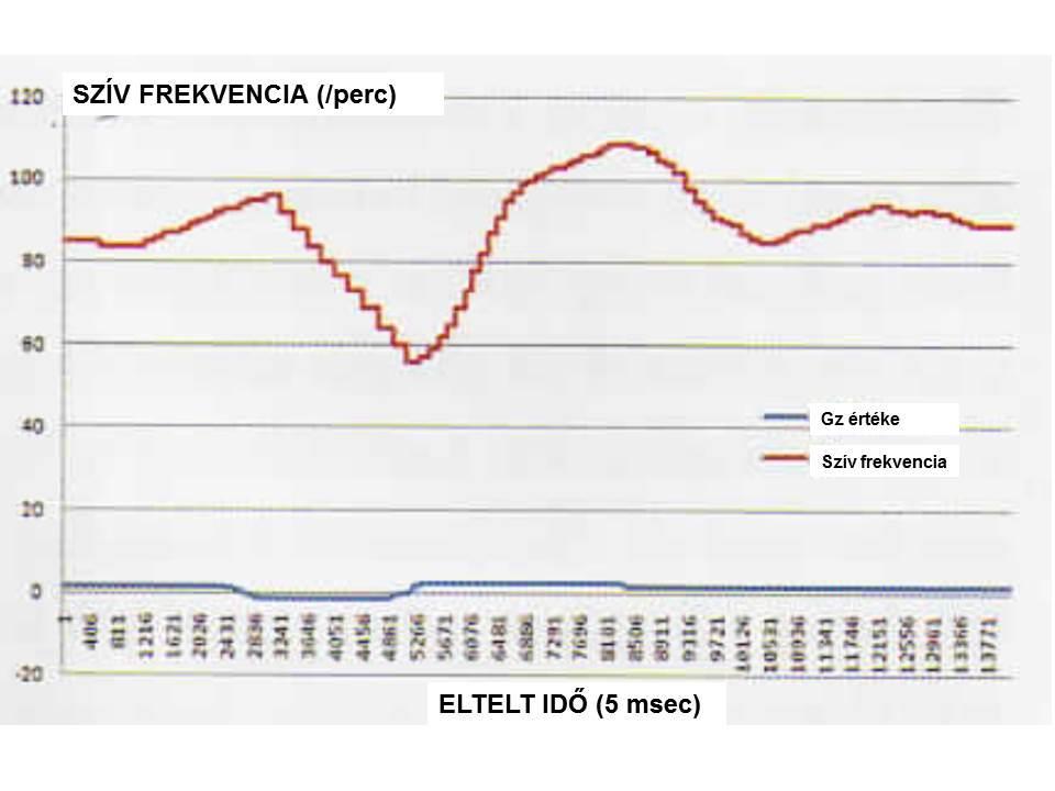 7. ábra Push-pull alatti orvosbiológiai (pulzus) monitorizálás Térbeli dezorientáció orvosbiológiai monitorizálása A térbeli dezorientáció esetében a pilóta hibásan érzékeli a helyzet- és a