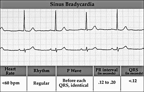 Bradycardia